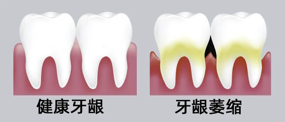 牙縫大露出“黑三角”，既塞牙又難看！還能恢復嗎？