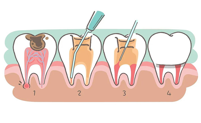 細(xì)說(shuō)根管治療，聽(tīng)聽(tīng)專家怎么講...