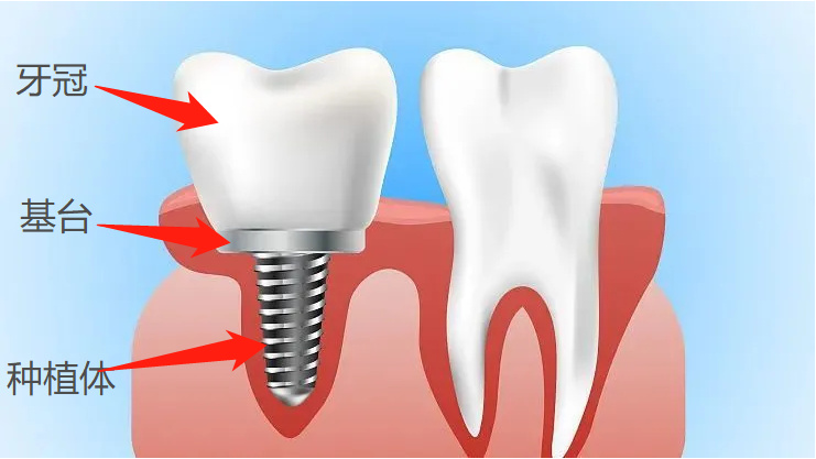 做了種植牙后悔的人都在想什么？一個牙醫(yī)良心科普解開缺牙疑惑